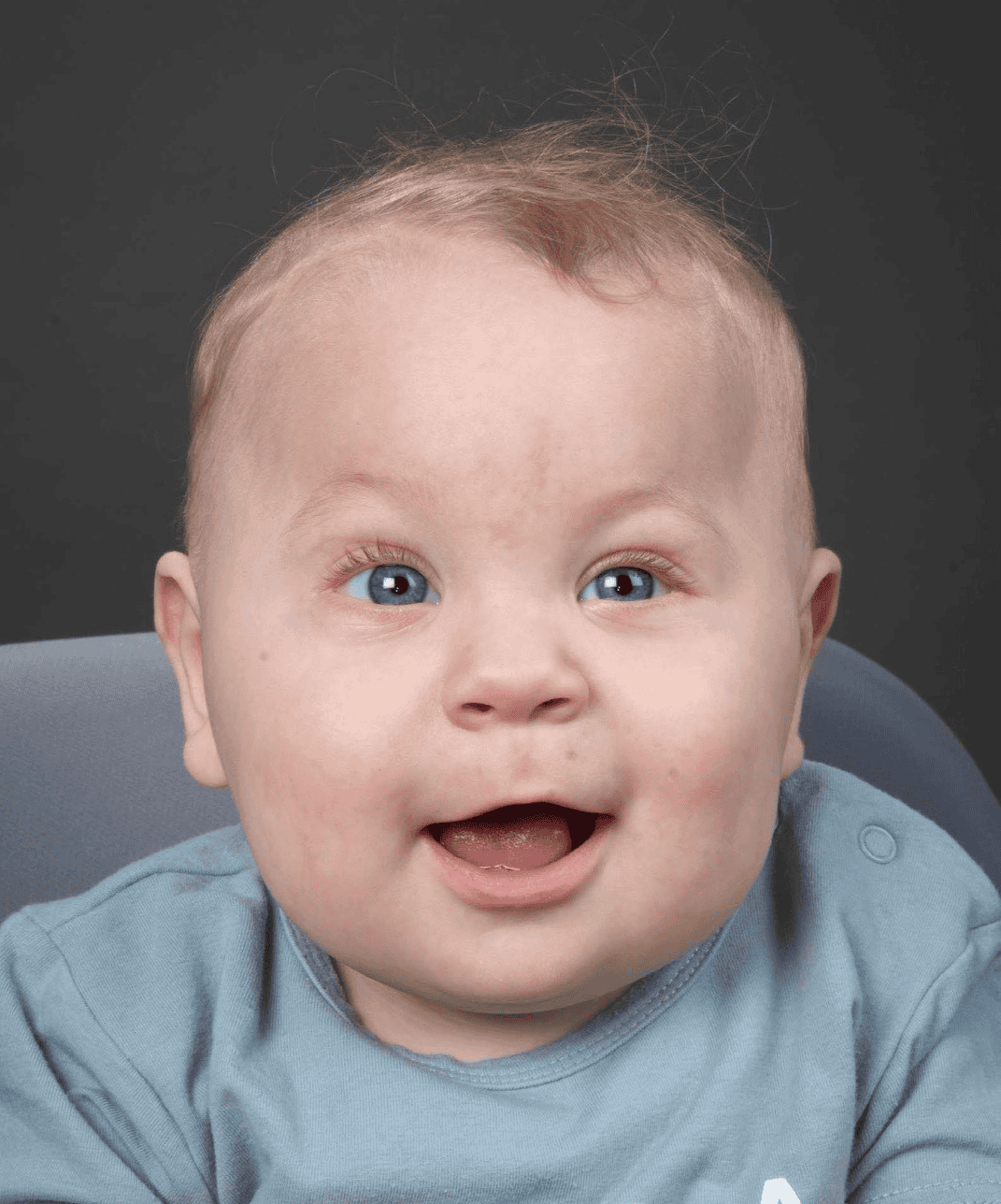 Baby with metopic synostosis and cystic fibrosis