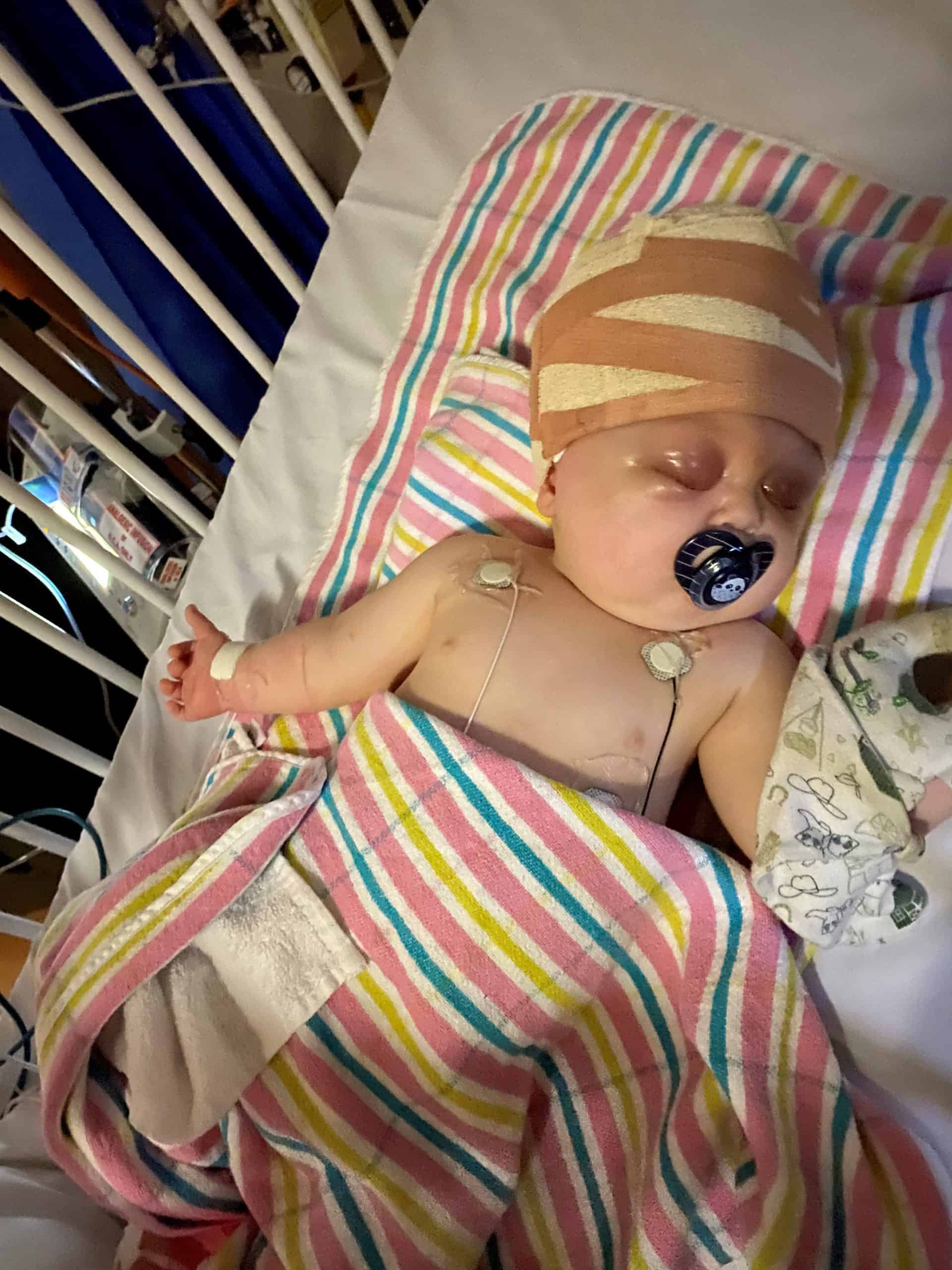 Baby with metopic synostosis and cystic fibrosis 