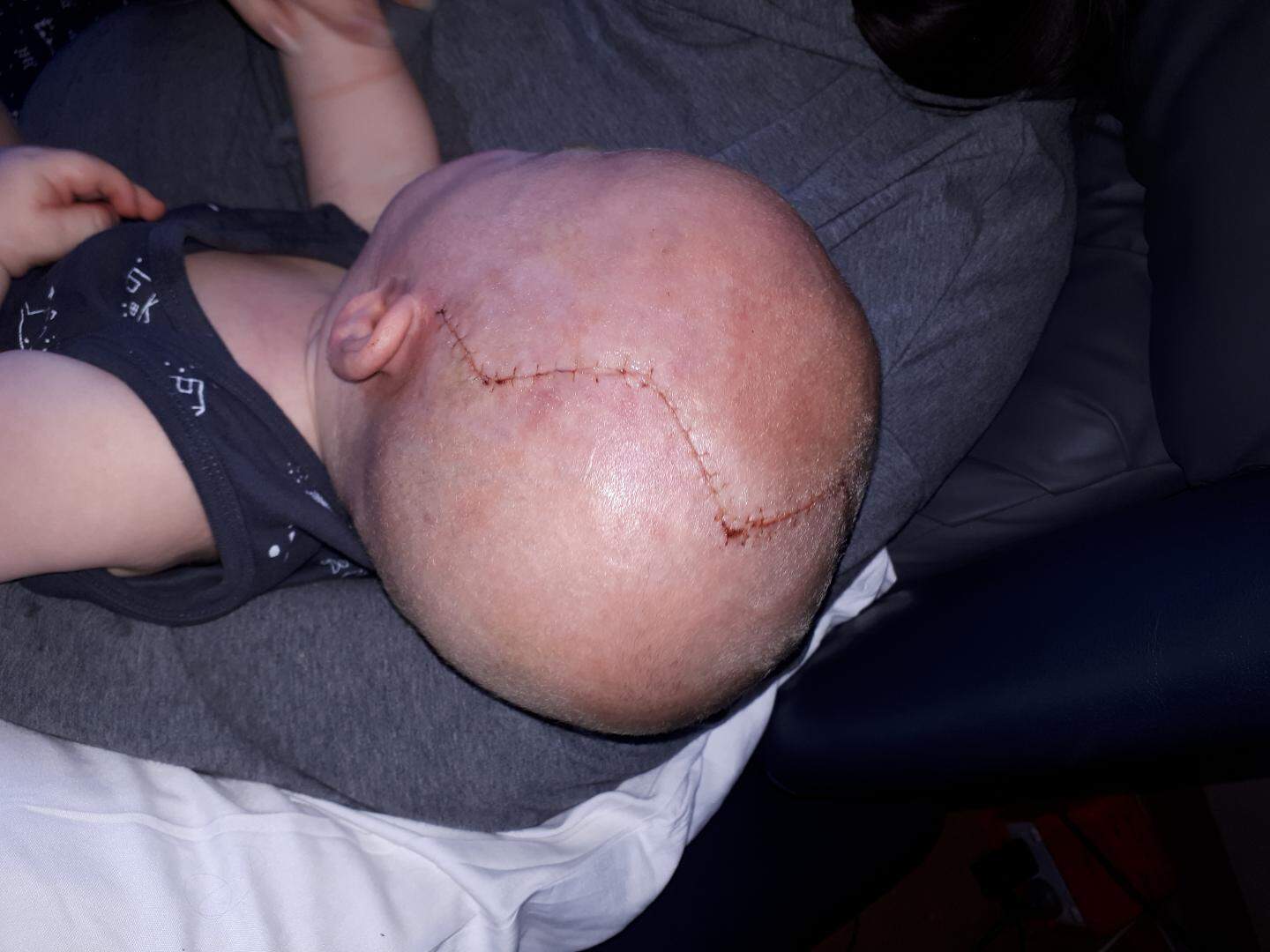 Baby with sagittal synostosis, showing scars after craniofacial surgery