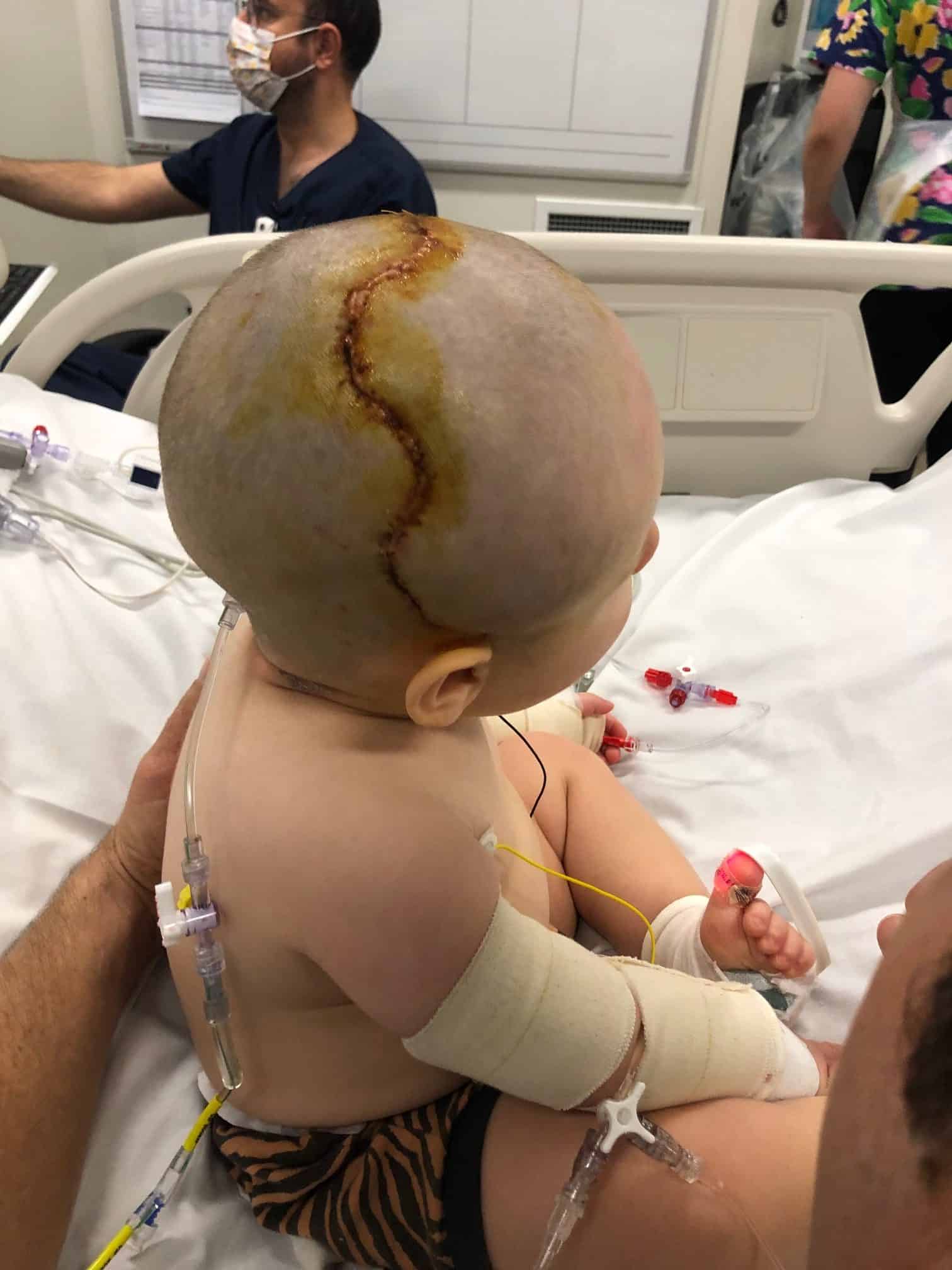 Baby boy with Hypoxic Ischemic Encephalopathy and Unicoronal synostosis showing scars on head following craniofacial surgery