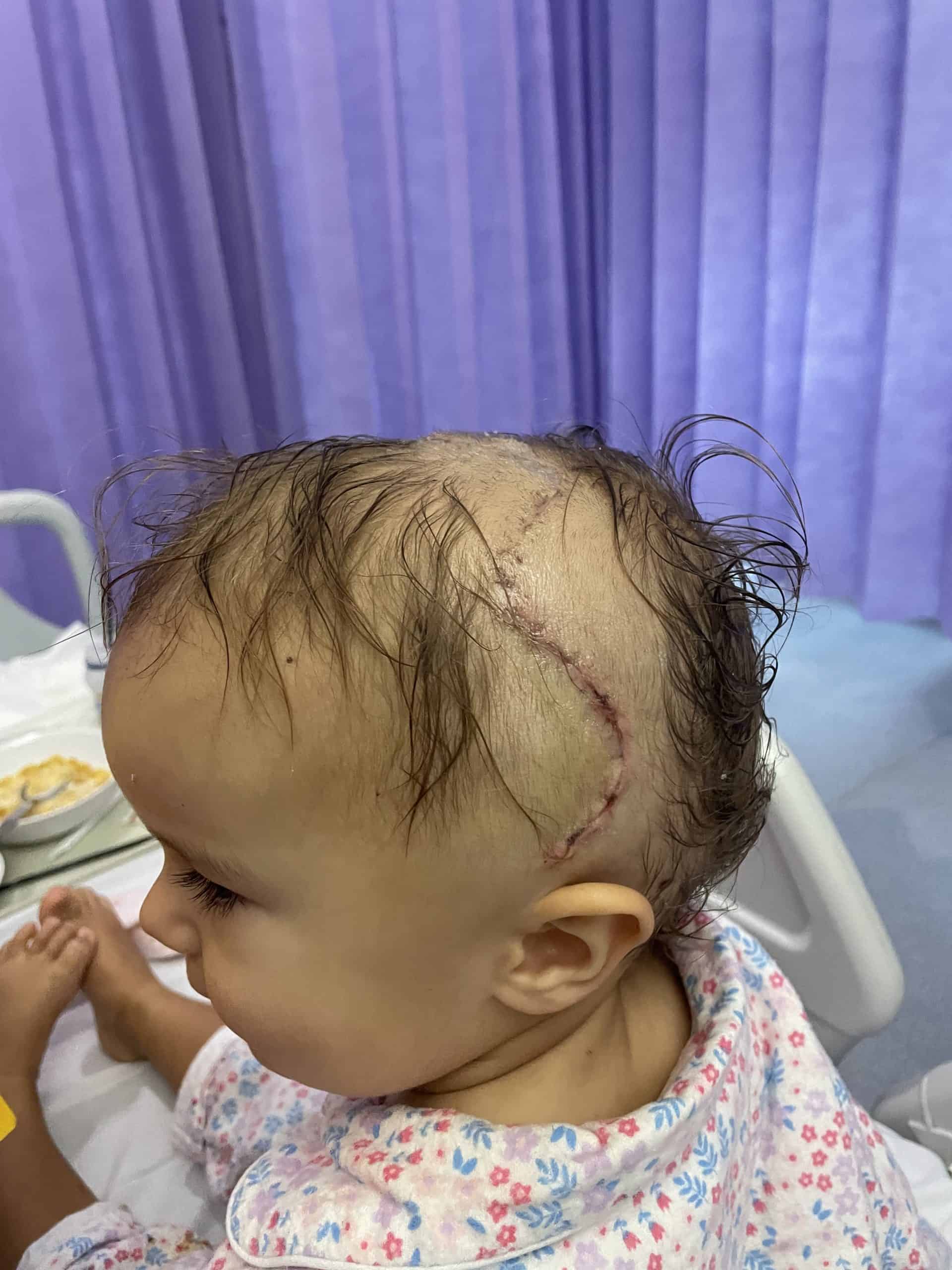 Girl with sagittal synostosis showing scars on head following surgery