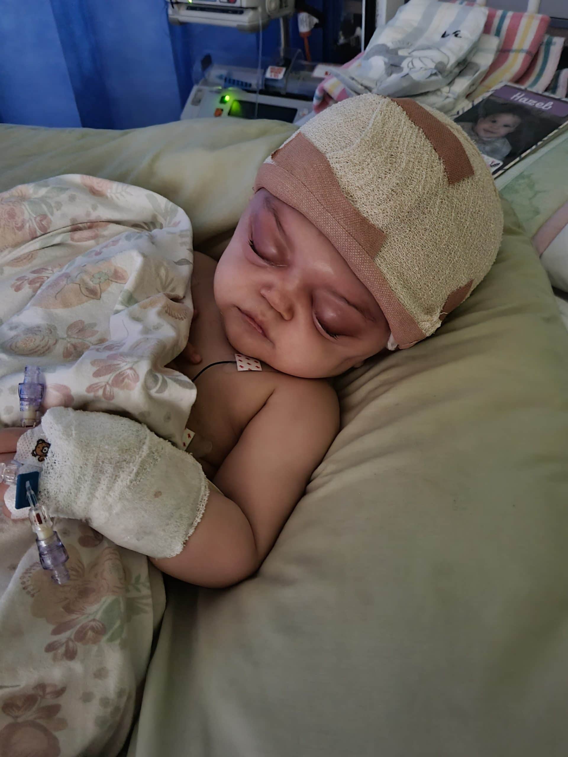 Baby with metopic synostosis wearing bandages on head, recovering after undergoing surgery