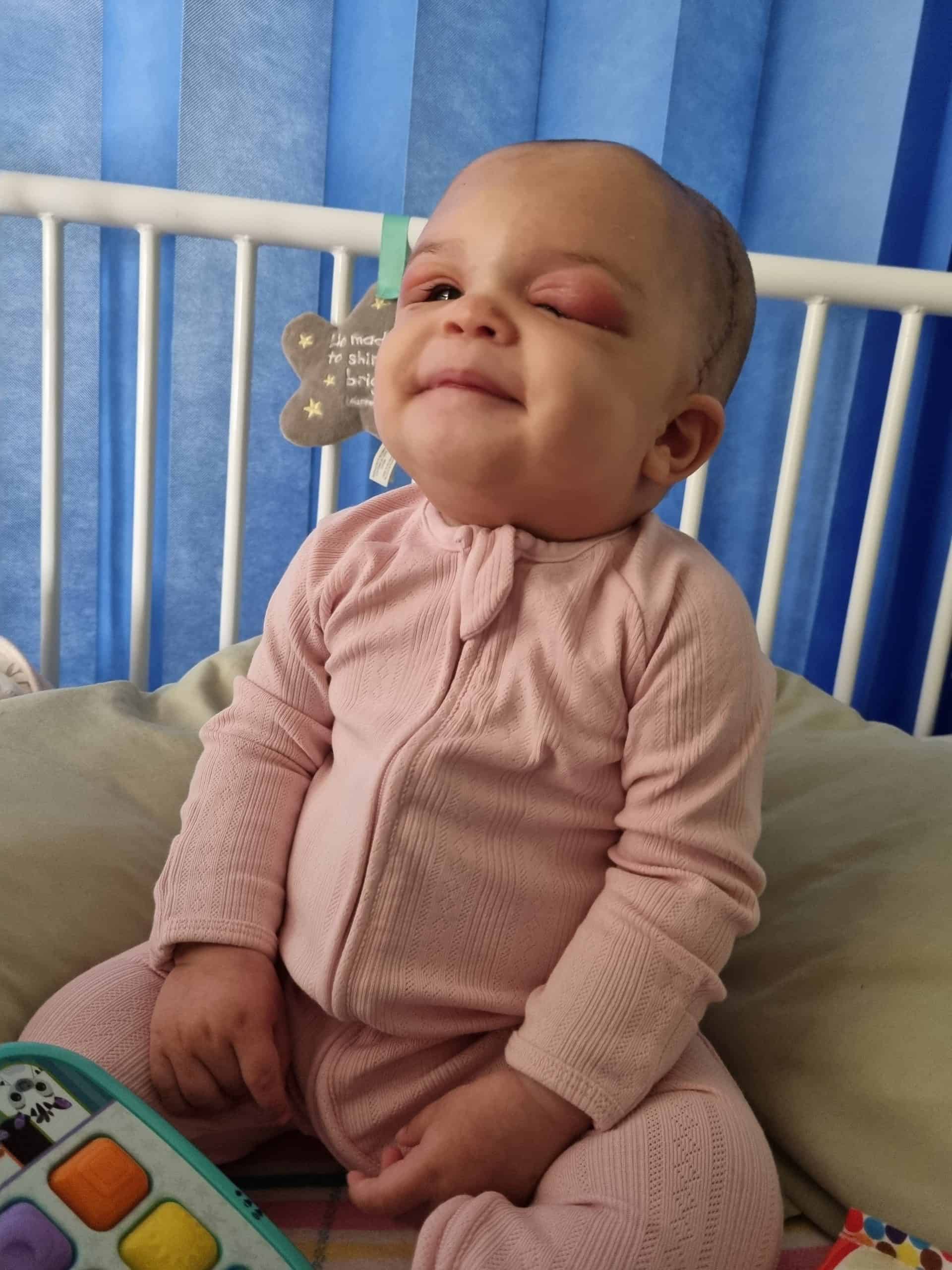 Baby with metopic synostosis recovering after undergoing surgery