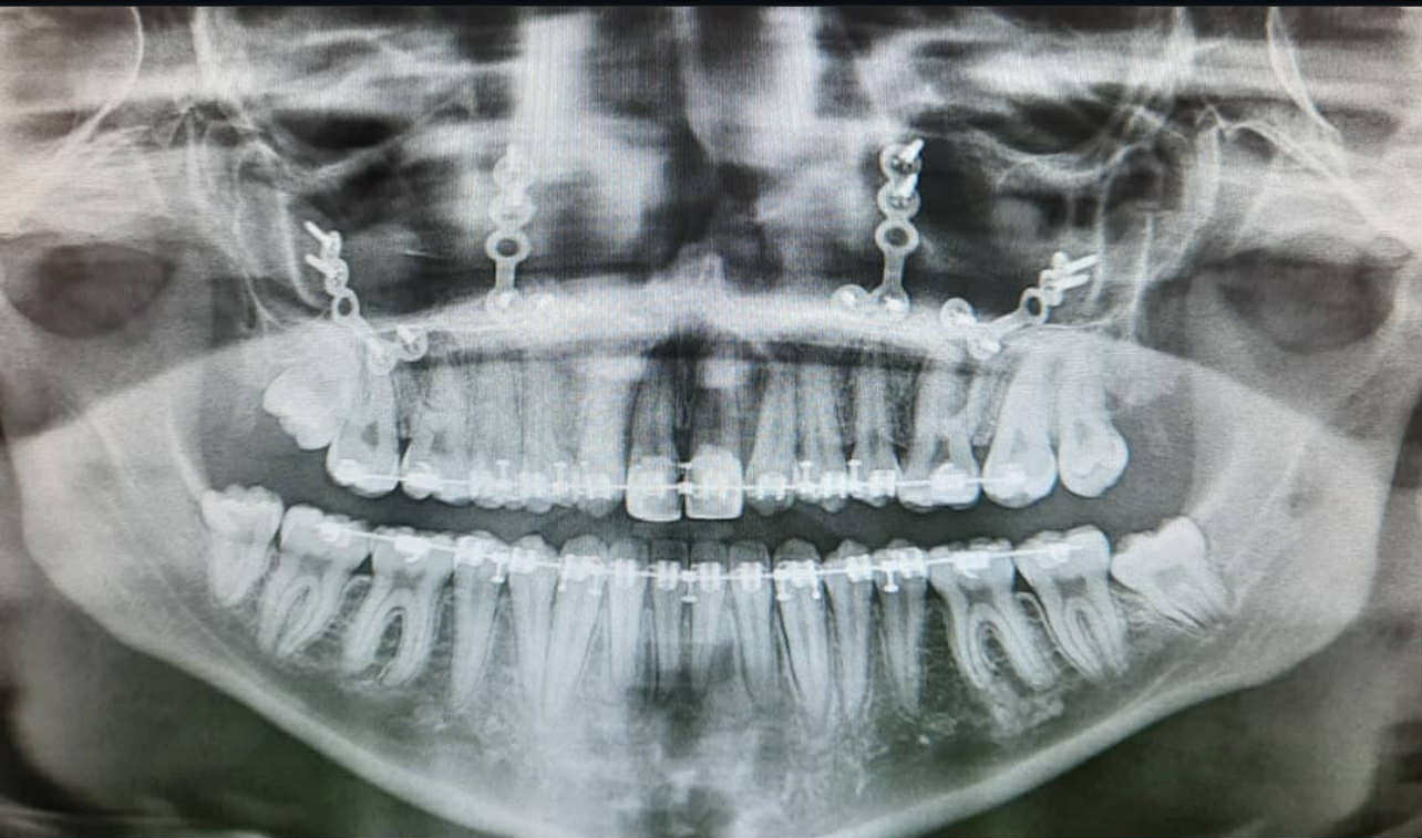 Teeth X-ray of a girl with cleft lip and palate