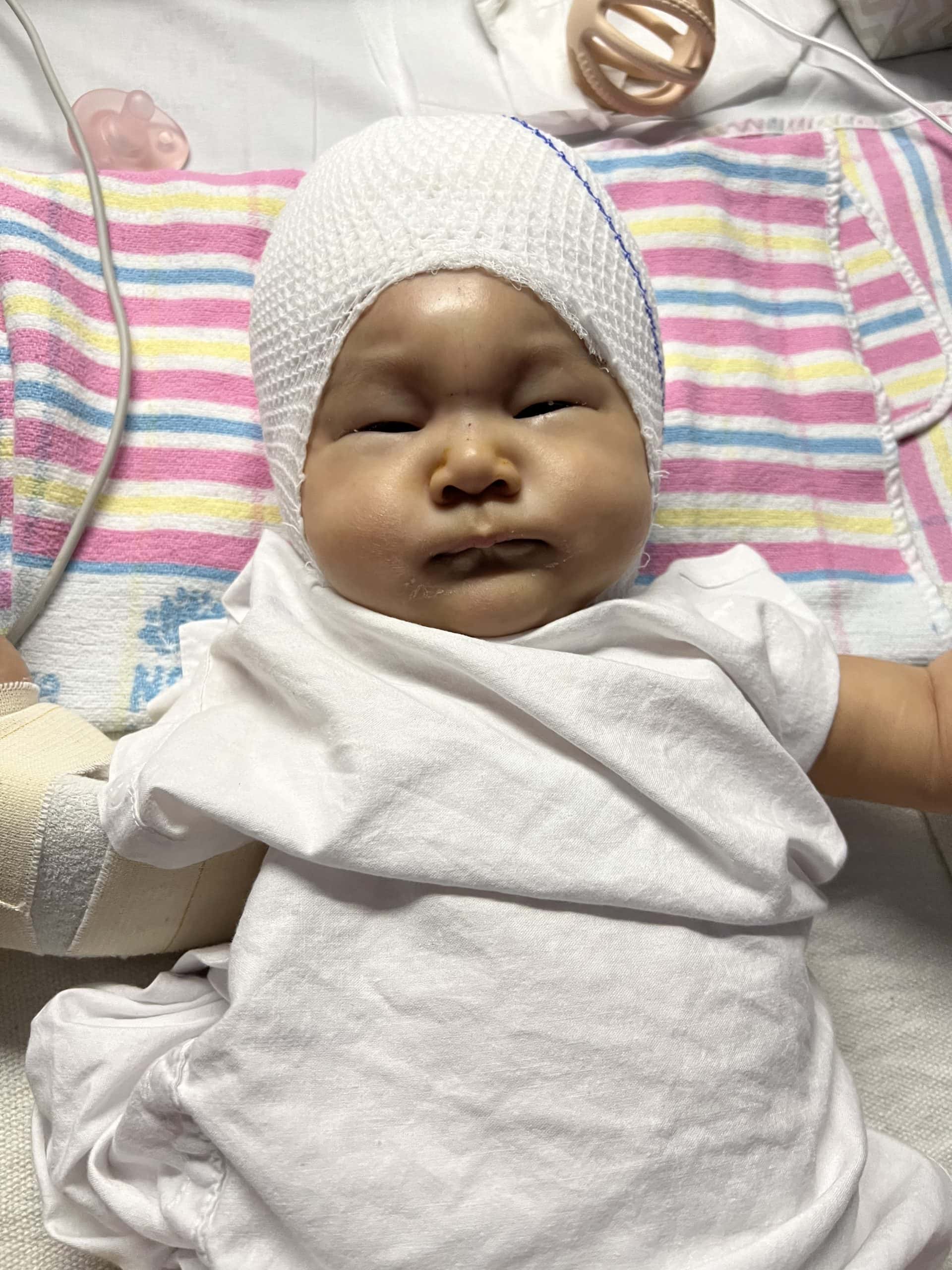 Baby with metopic synostosis in hospital bed with bandage on head, medical equipment visible.