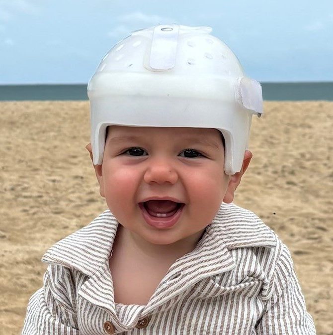 Happy baby wearing a helmet at the beach, showcasing craniofacial care and support.
