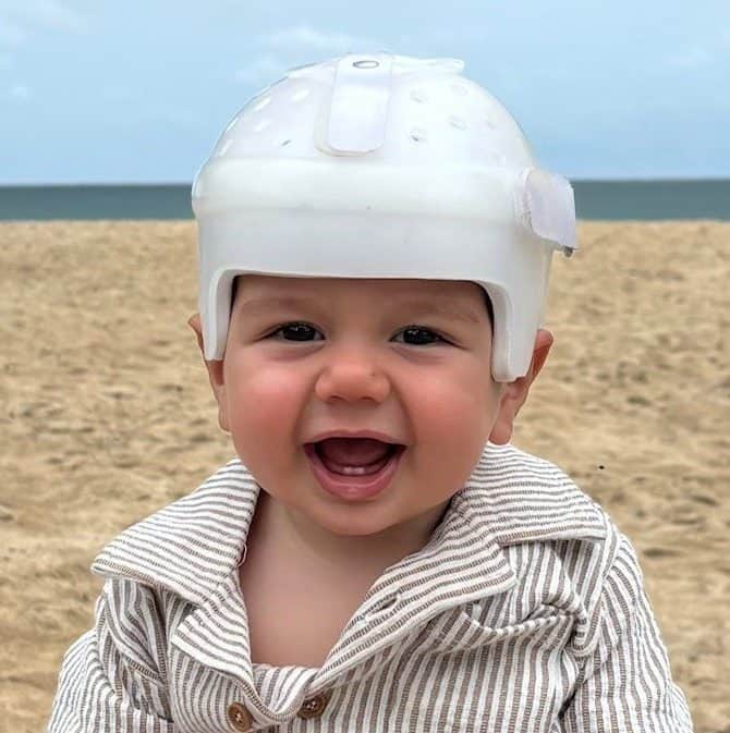 Bright smiling toddler wearing a protective helmet on the beach, showcasing craniofacial care and tr.