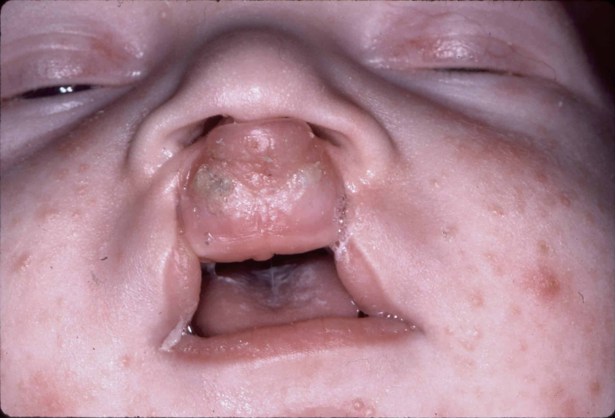 Close up of baby with cleft lip and palate