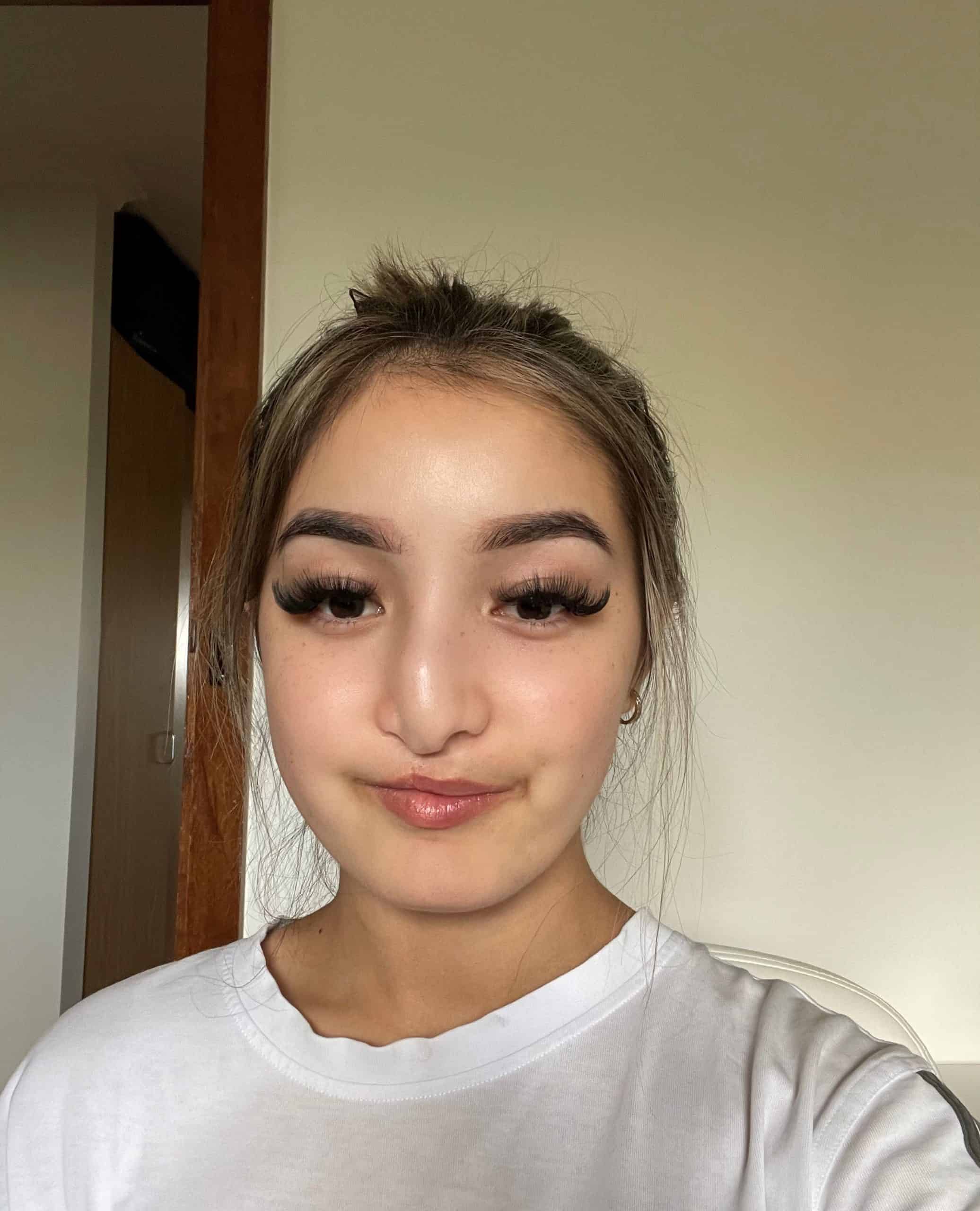 Young woman with cleft lip and palate.