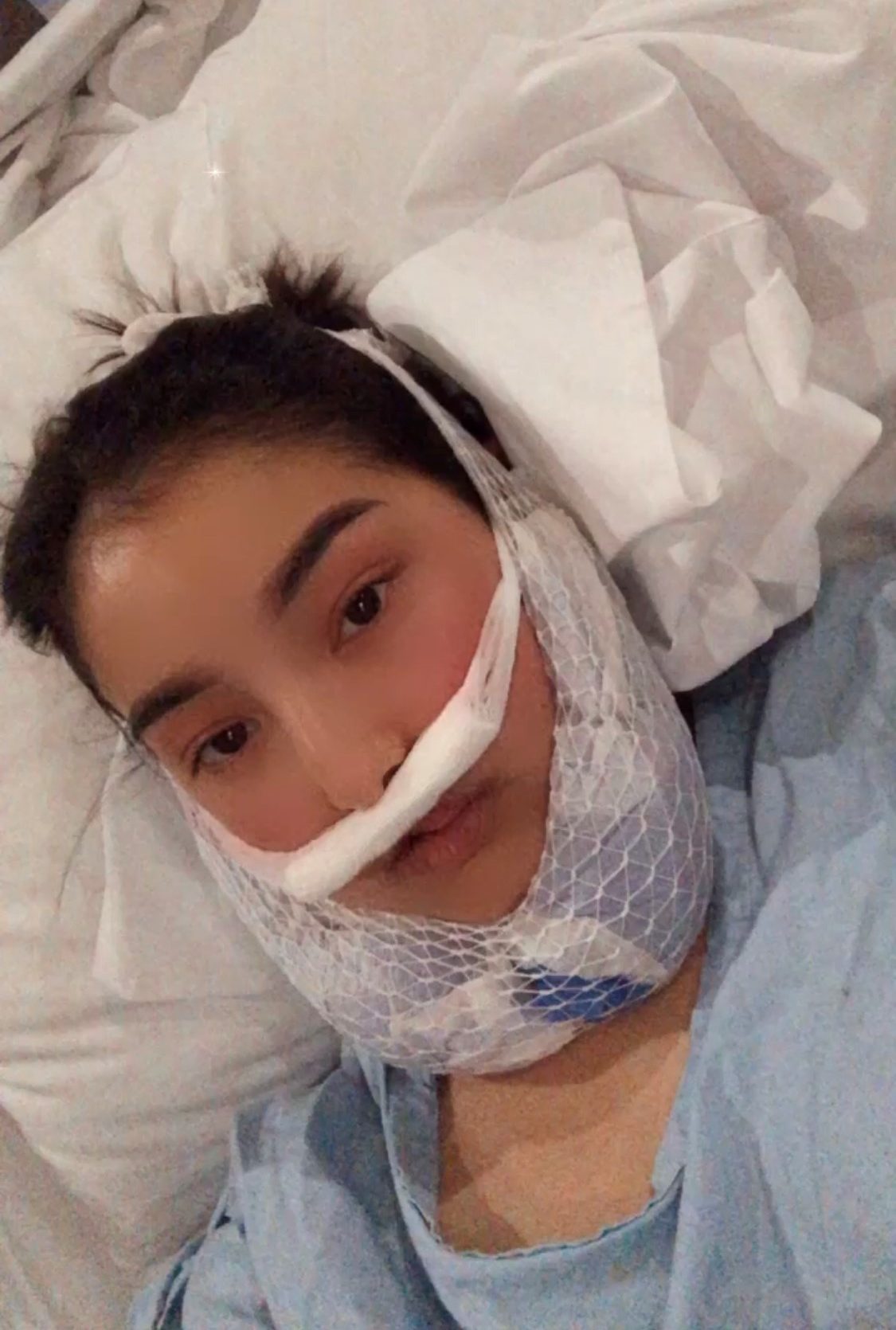 Young woman with cleft lip and palate lying in hospital bed following surgery with bandages on face.