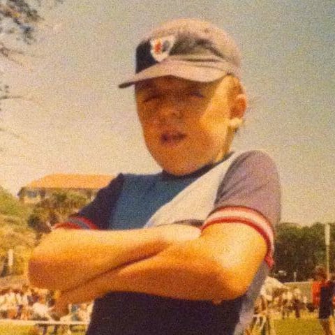 Boy with Apert syndrome