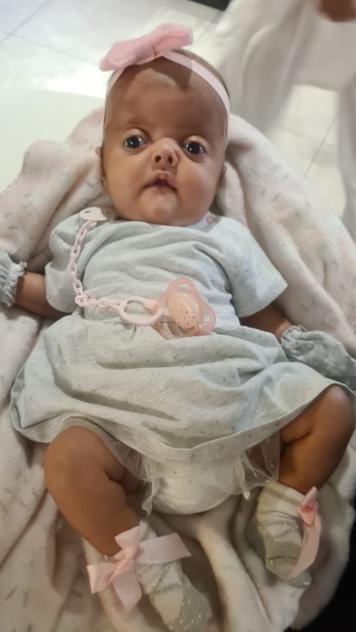 4 month old Pakistani girl with Apert syndrome