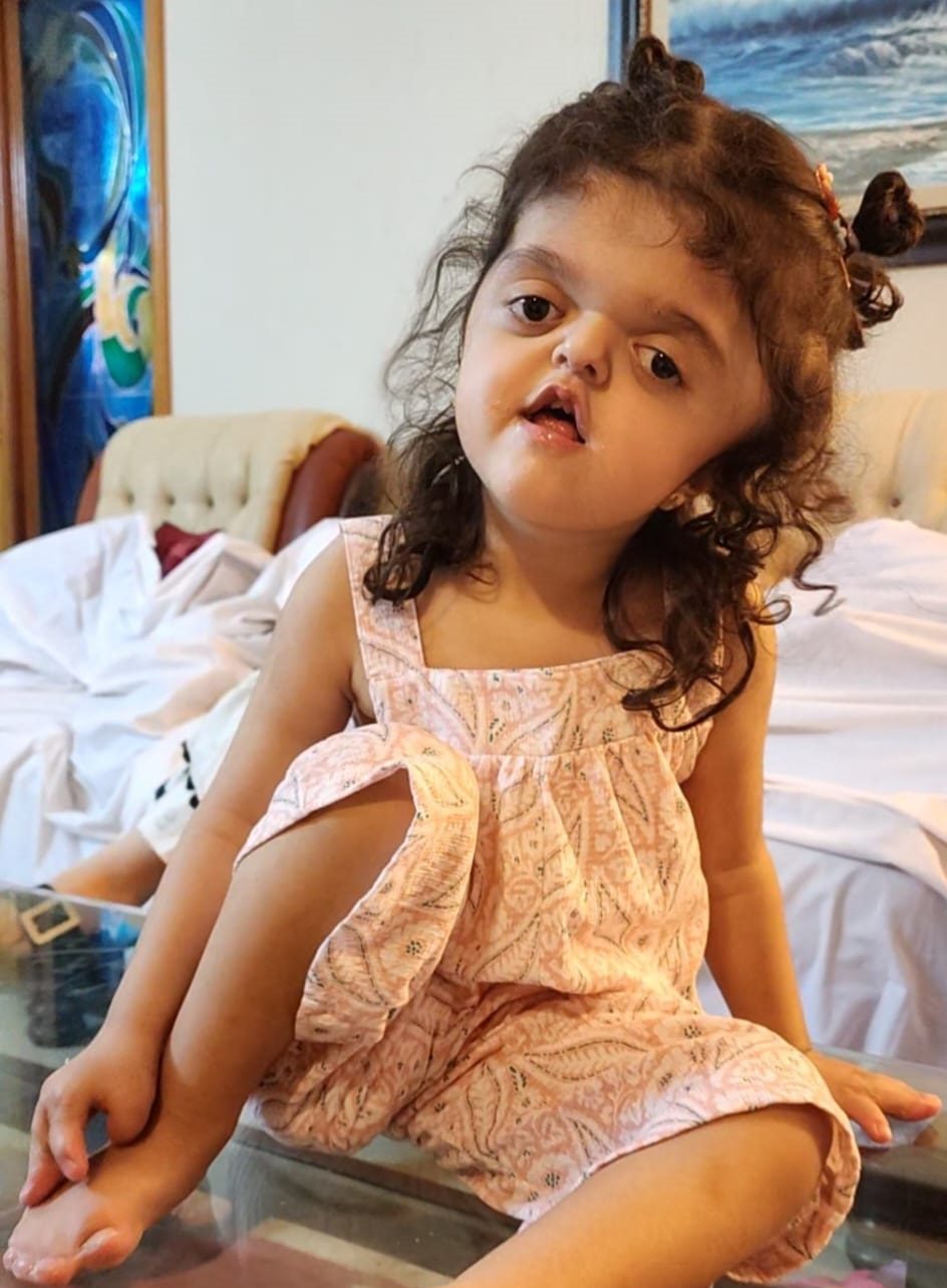3 year old girl from Pakisan with Apert syndrome