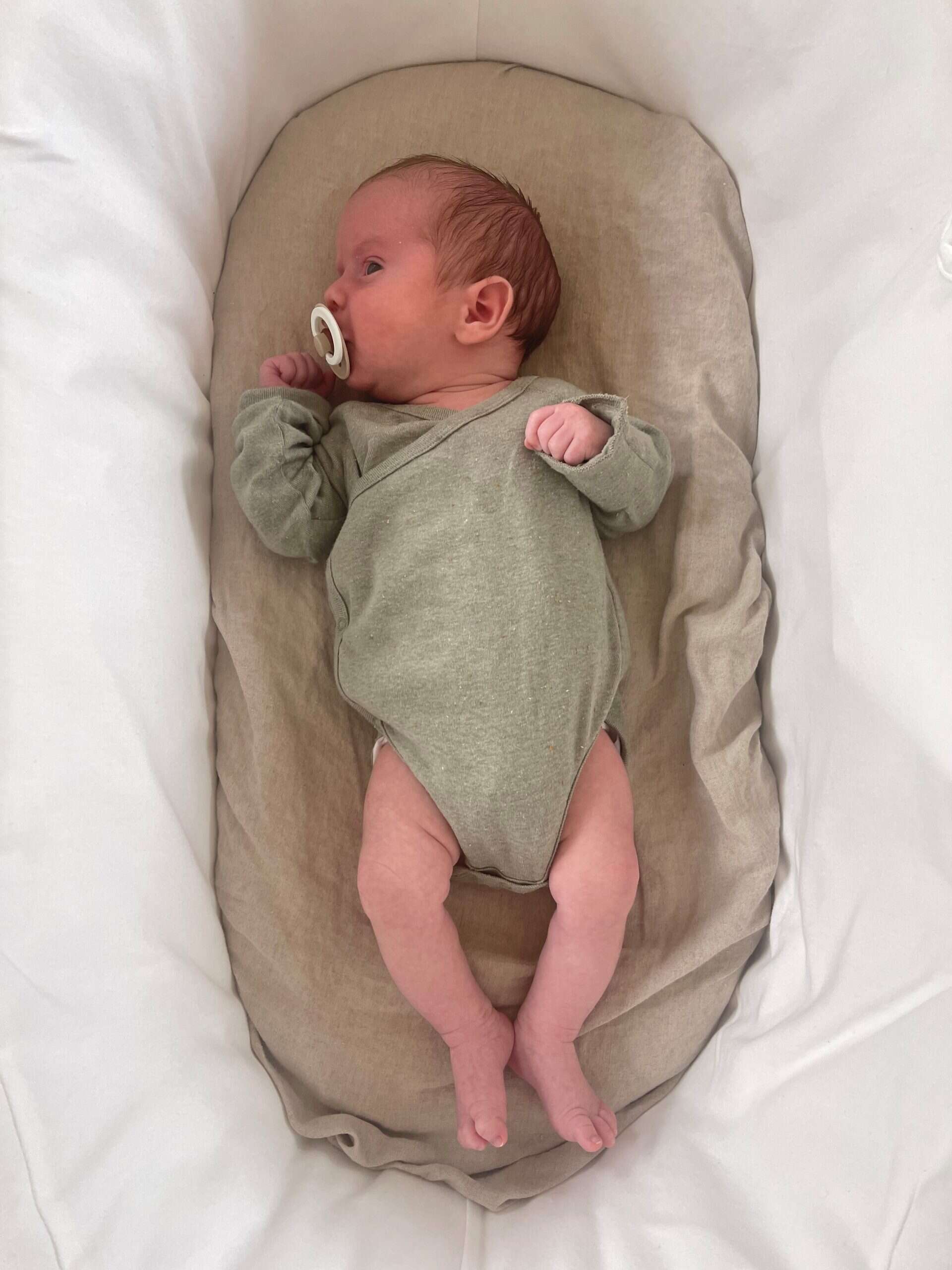 Preterm baby with craniofacial condition lying in hospital bassinet, pacifier in mouth.