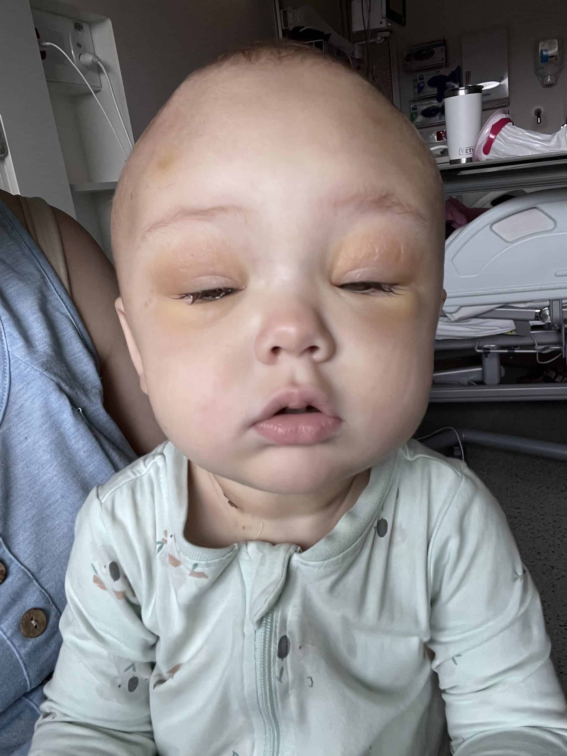 A child with craniofacial condition in hospital, Addie's story, craniofacial surgery.