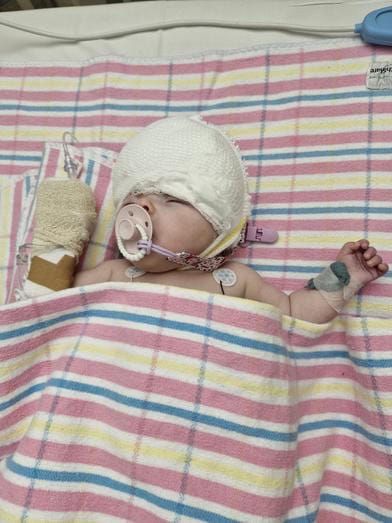 Infant with craniofacial condition in hospital bed with medical devices.