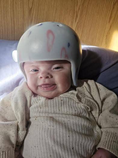 Baby wearing a helmet with pink and blue markings, lying on a bed.