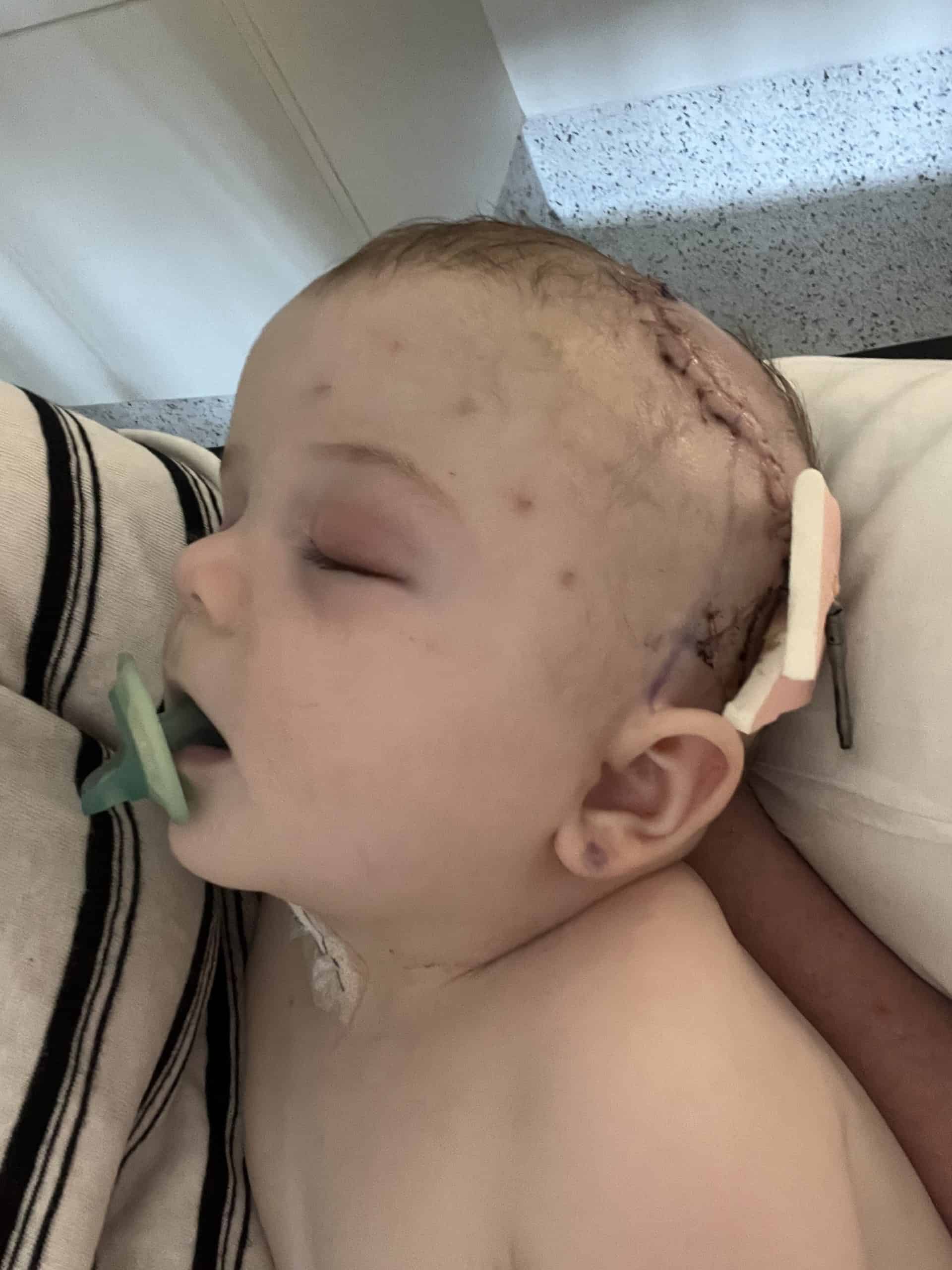 Child with craniofacial surgery scars and medical devices after craniofacial surgery.