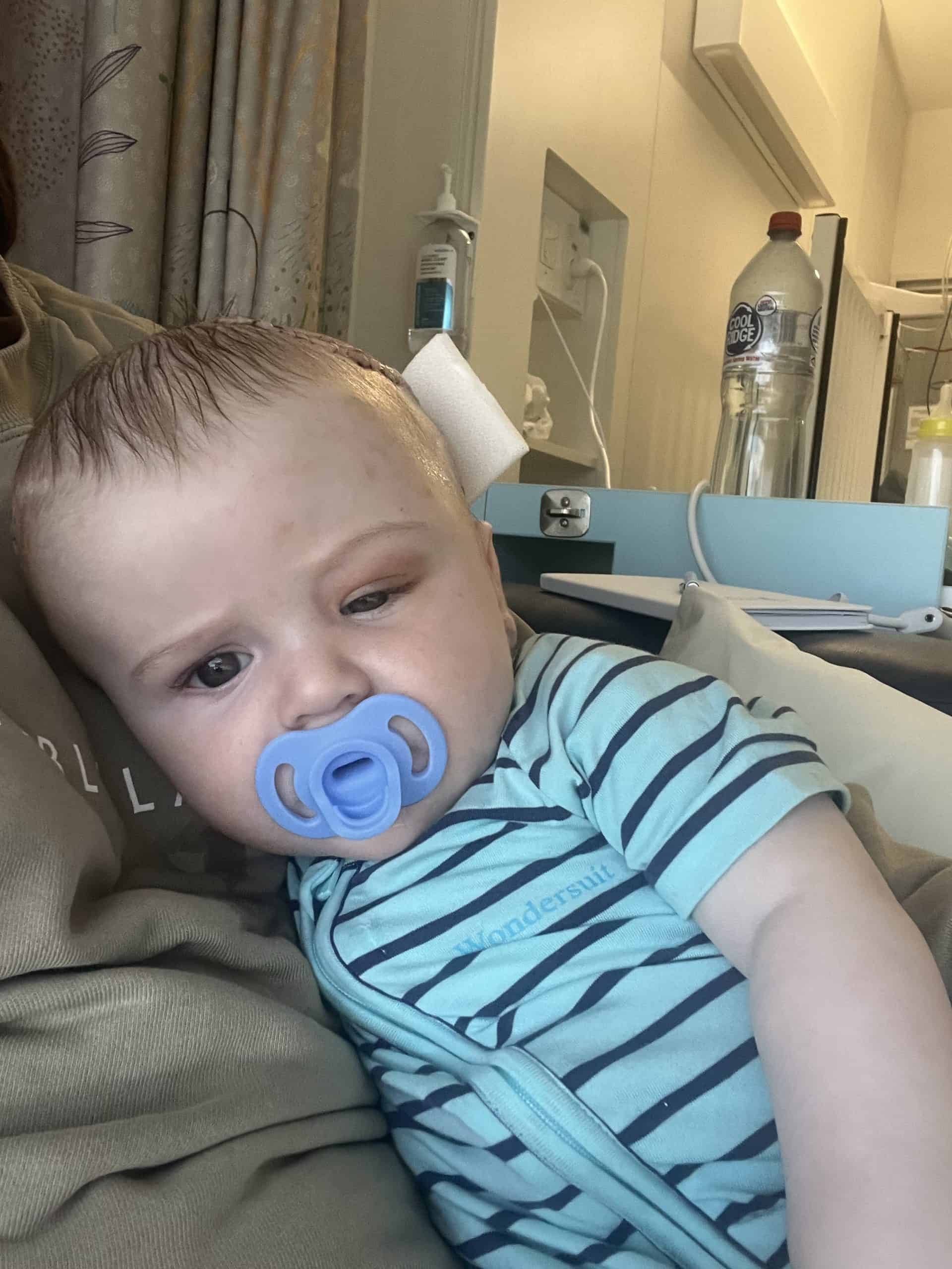 Young boy with a pacifier in hospital bed after craniofacial surgery.