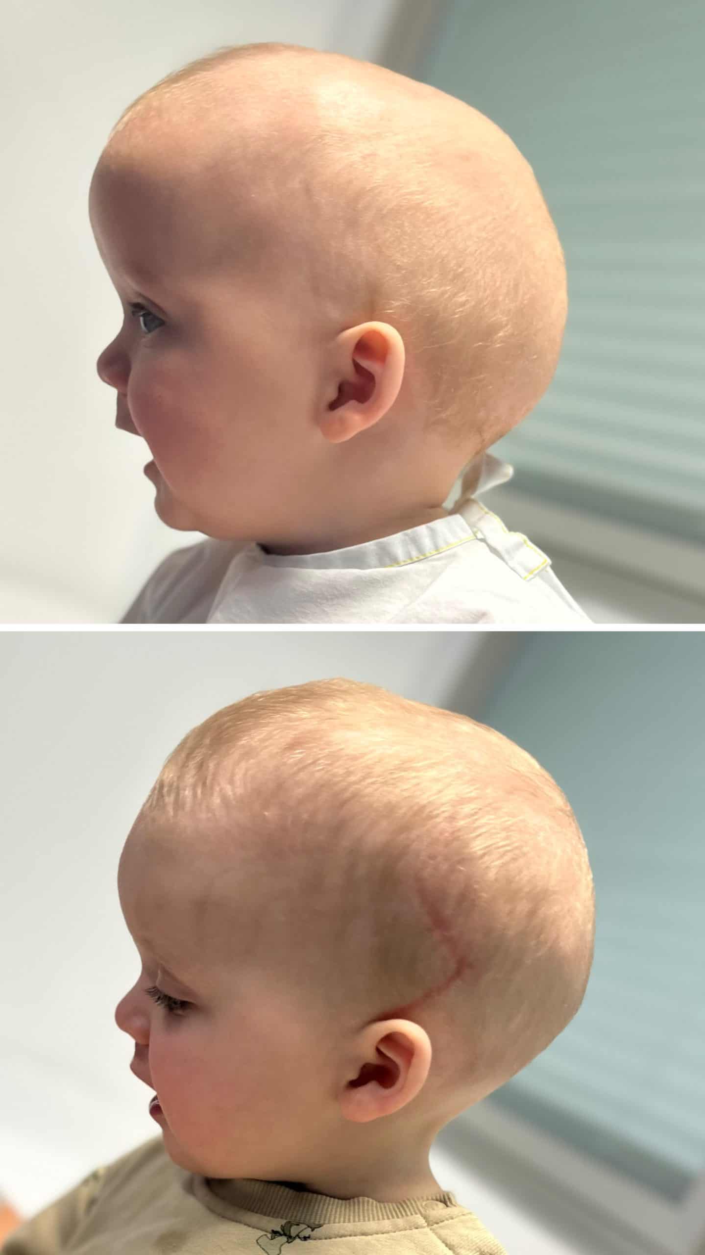 Child with craniofacial condition before and after treatment at Craniofacial Australia.